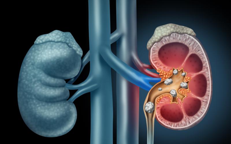 blog-kidney-stones